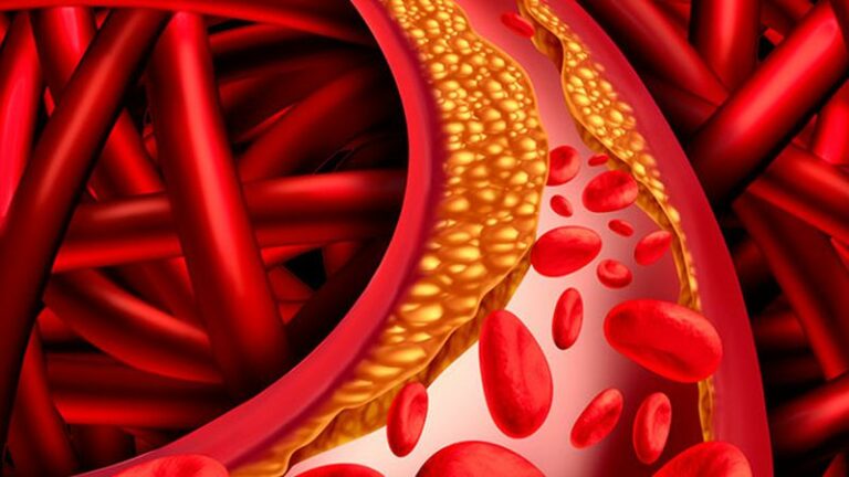 Dislipidemia aterogena - Data Center Solutions